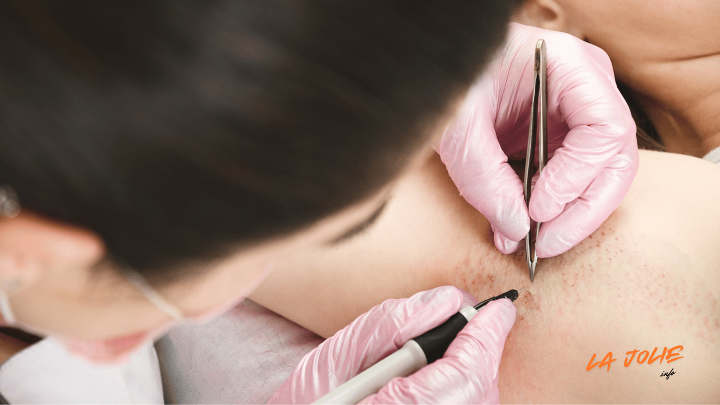 Professional Hair Removal